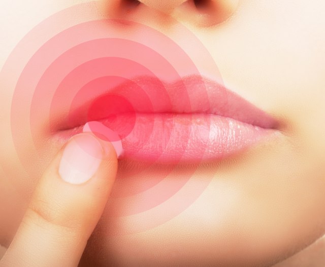 Evo šta izaziva herpes na usni i kako ga spreèiti